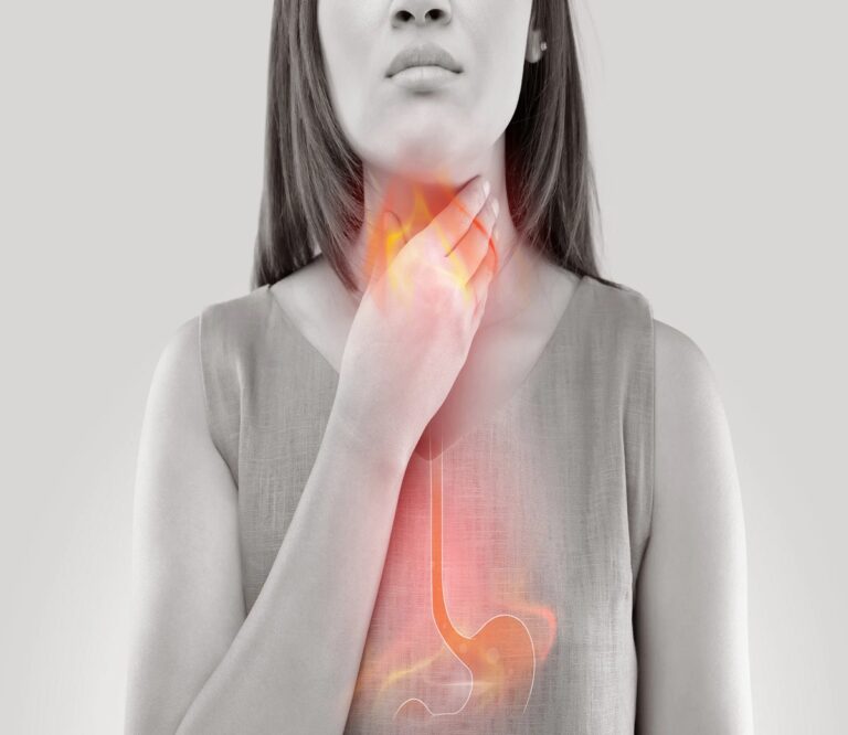 Acid Reflux